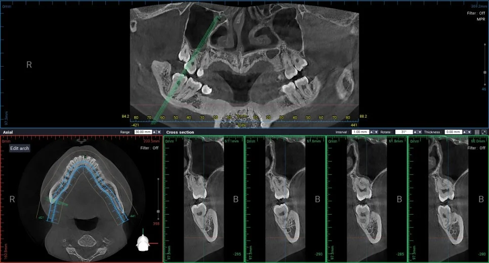 사랑니 CBCT 3D 촬영 신경관 위치 확인