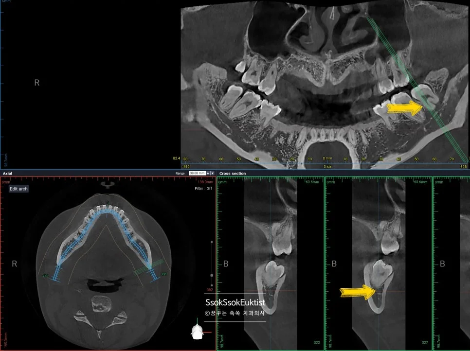 CBCT 3차원 촬영 왼쪽 사랑니 신경관 완전히 붙어있는 상태