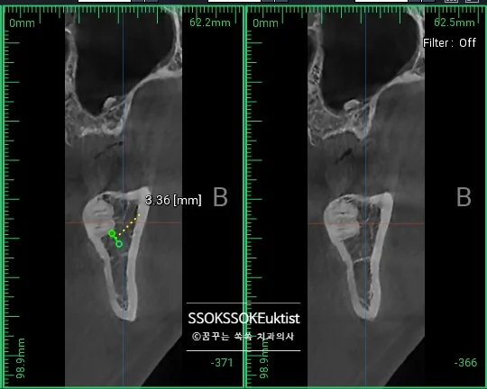 사랑니 CBCT 하치조신경관 거리 측정