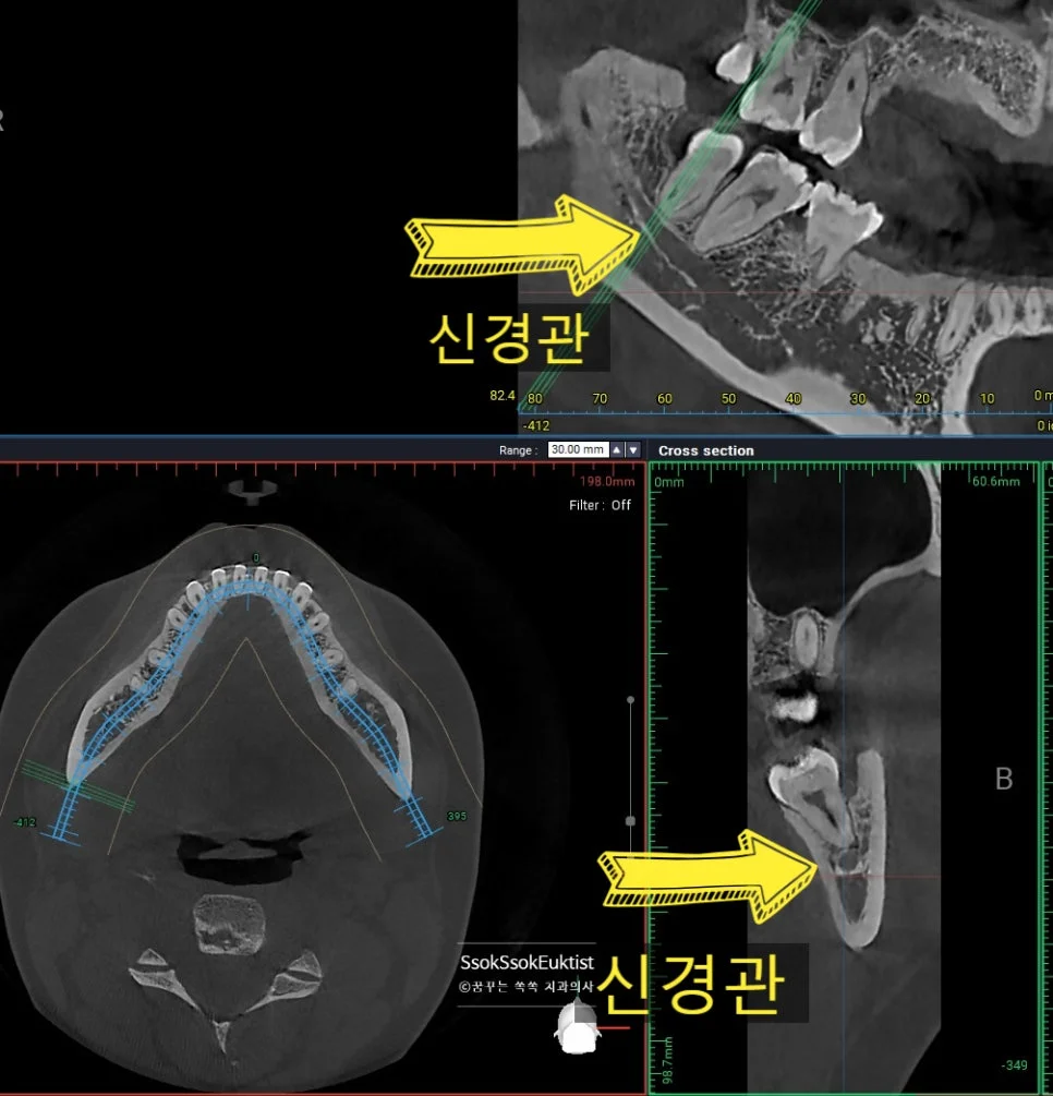 CBCT 3차원 촬영 오른쪽 사랑니 신경관 거리 1mm 미만