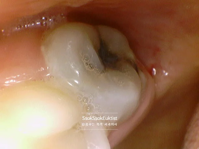 충치 사랑니 다른 각도 임상사진 잇몸 상태 확인