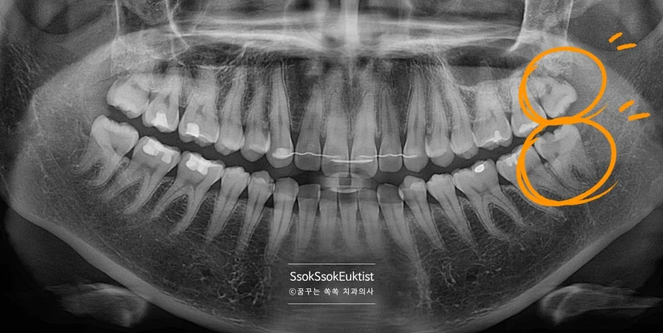 쉬운 난이도 충치 있는 사랑니 구내사진 왼쪽 위아래
