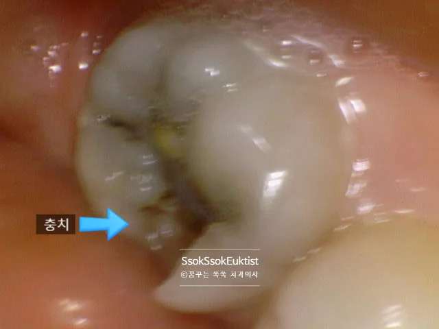 충치 사랑니 측면 임상사진 색상 변화 관찰