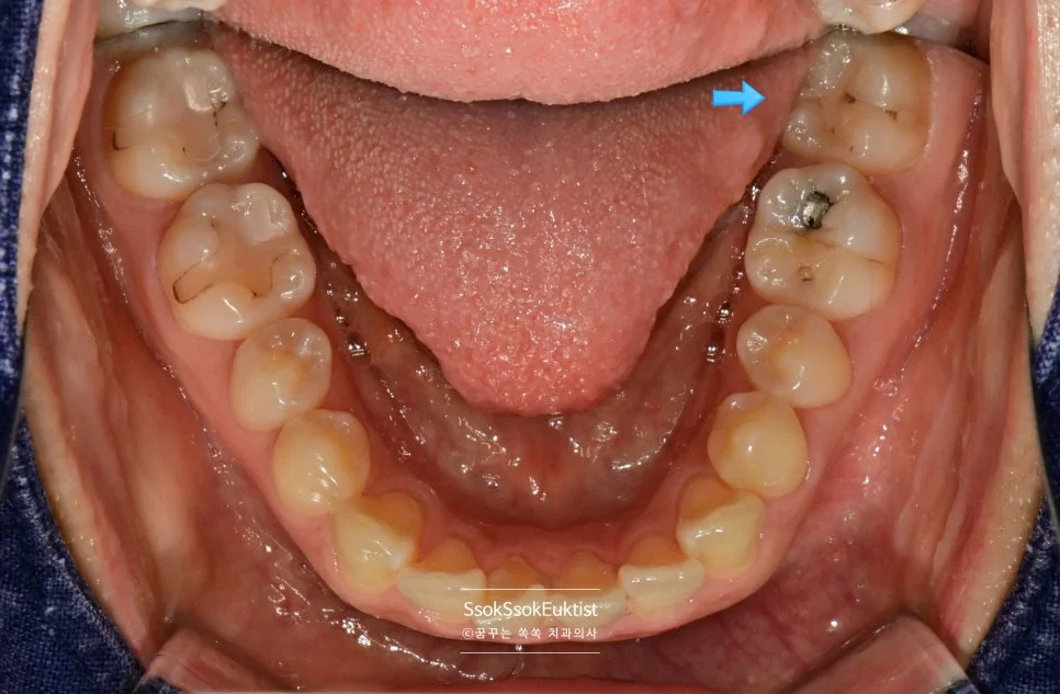 하악 사랑니 구내사진 화살표 표시 맹출 상태