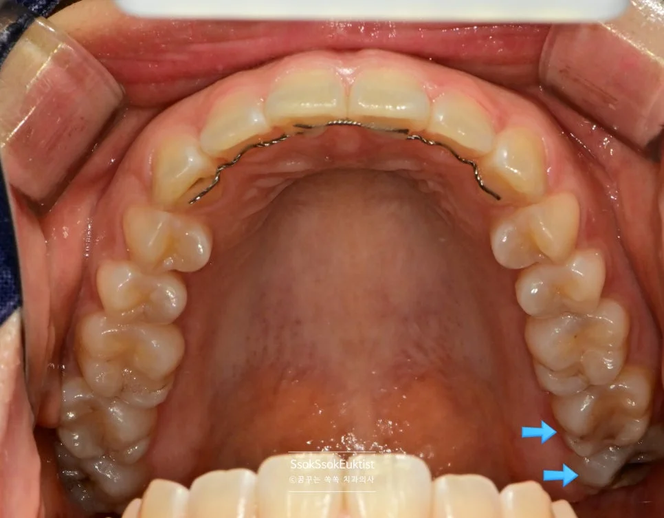 상악 사랑니 구내사진 화살표 표시 충치 위치