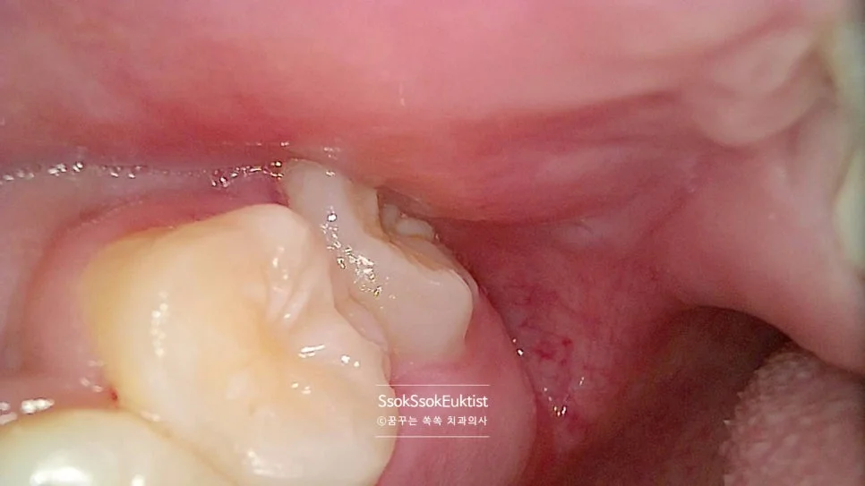턱뼈에 걸린 사랑니 구내사진 잇몸 부종 염증 상태