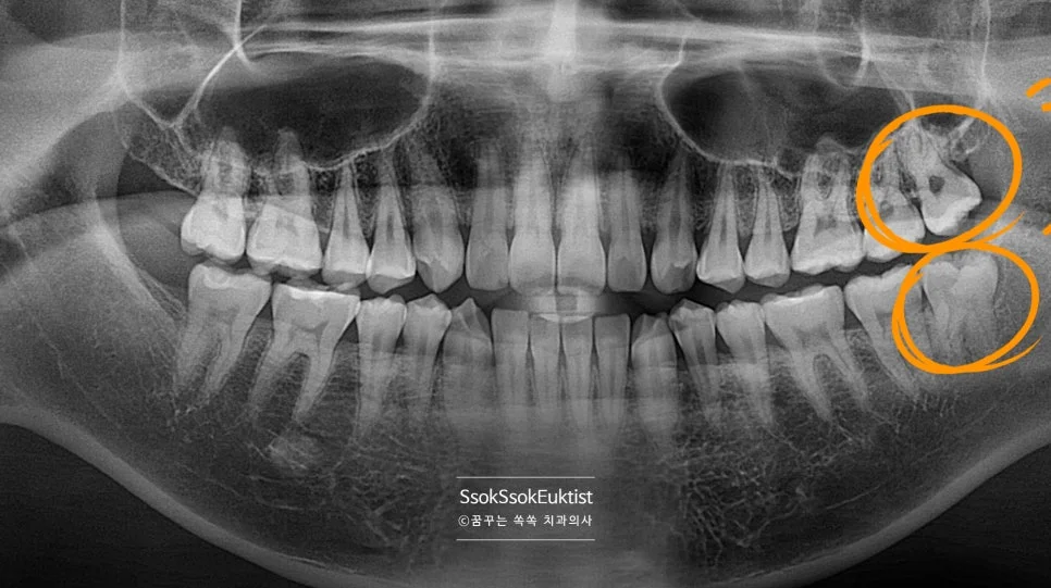 쉬운 난이도 하악 사랑니 파노라마 엑스레이 턱뼈 걸림