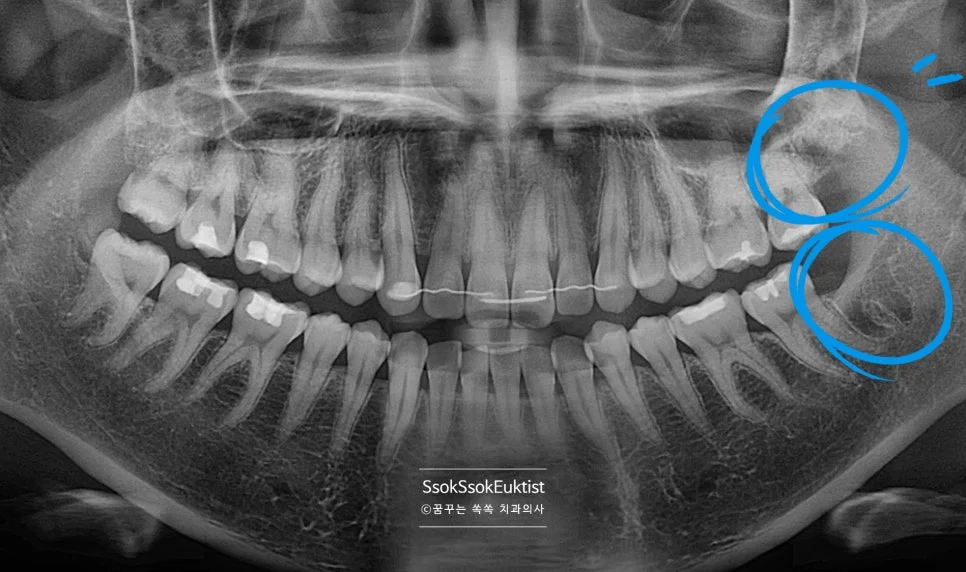 쉬운 난이도 사랑니 파노라마 엑스레이 상악 정상 맹출