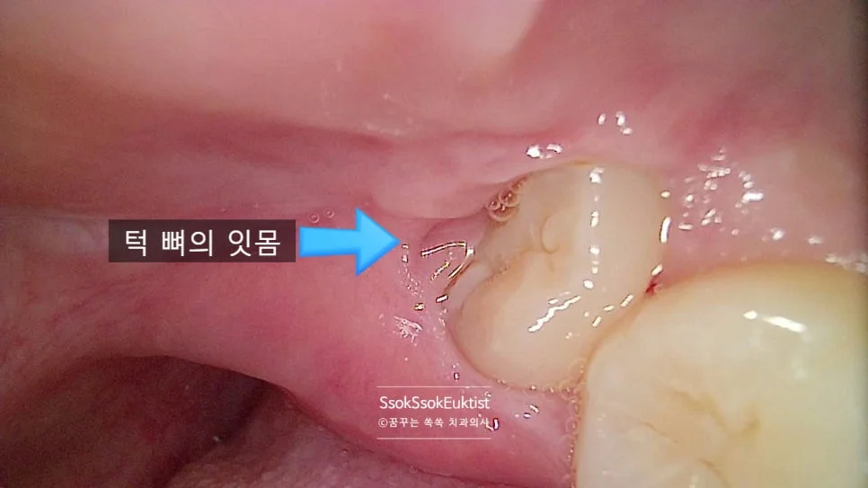 턱뼈에 걸린 사랑니 파노라마 엑스레이 주황색 원 표시