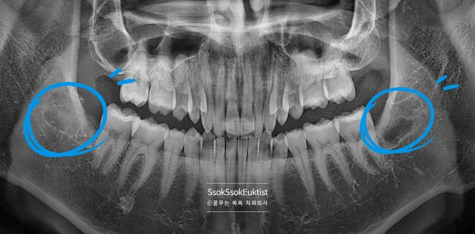 어려운 사랑니 발치 후 파노라마 엑스레이 완벽 제거 확인
