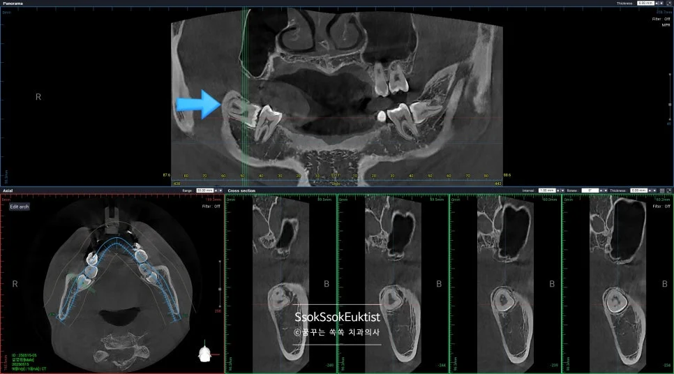 어려운 난이도 사랑니 CBCT 3차원 영상 복잡한 뿌리 형태