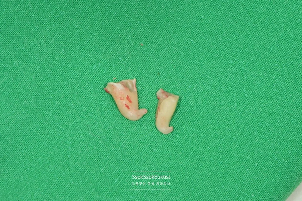 발치된 사랑니 실제 뿌리 사진 갈고리 모양 복잡한 형태