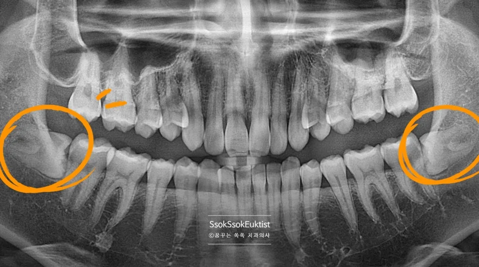 어려운 난이도 완전 매복 사랑니 파노라마 엑스레이 수평 매복