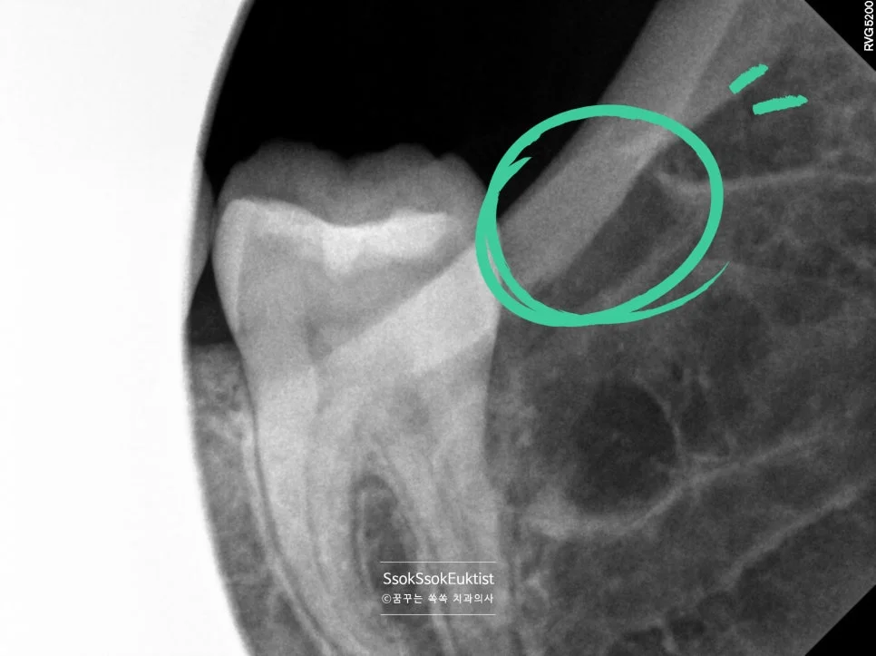 어려운 사랑니 엑스레이 복잡하게 휘어진 갈고리 뿌리