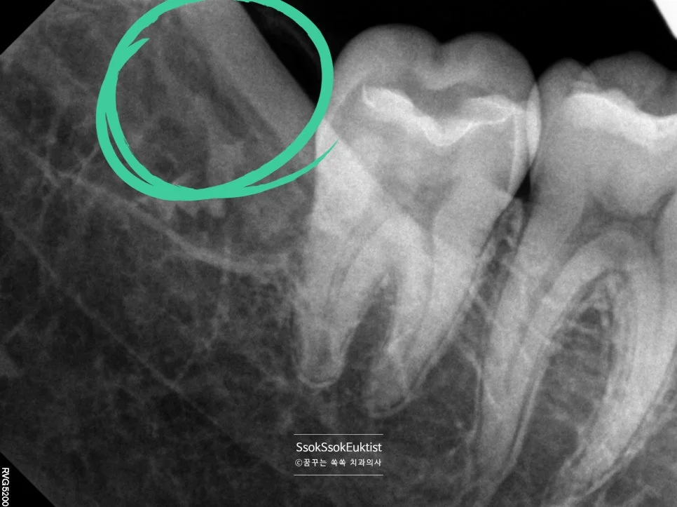어려운 매복 사랑니 엑스레이 녹색 원 신경관 근접