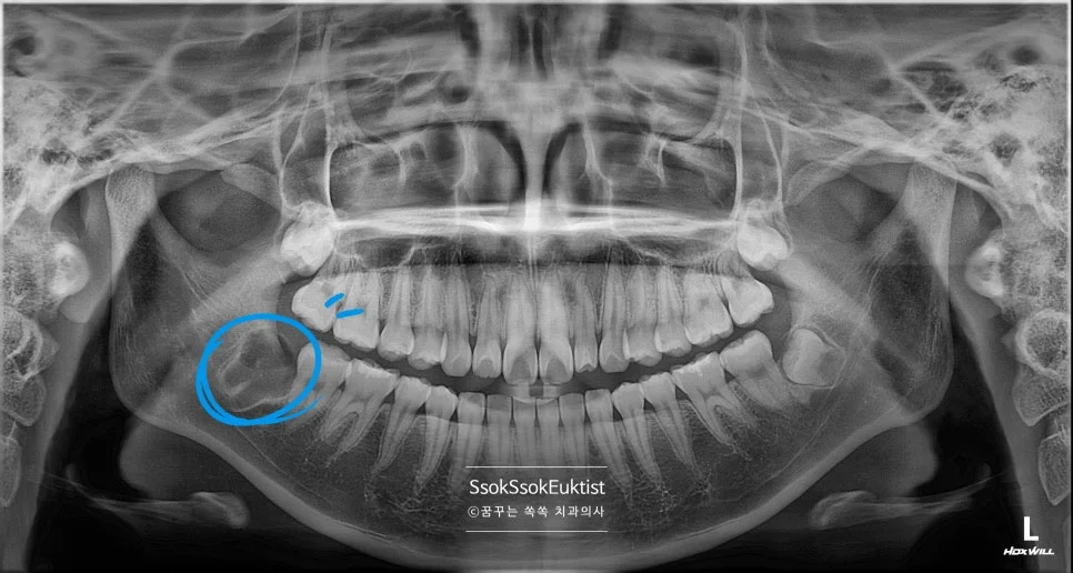 중간 난이도 사랑니 발치 후 엑스레이 잔존 뿌리 없음