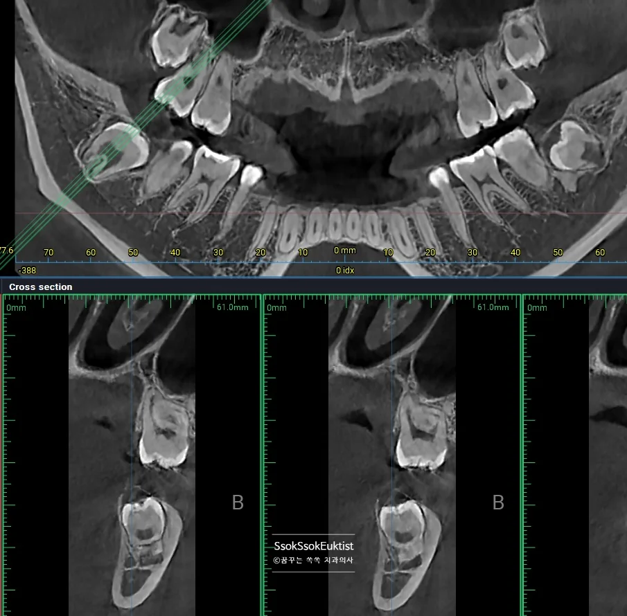 중간 난이도 사랑니 CBCT 3차원 영상 신경관 인접 관계