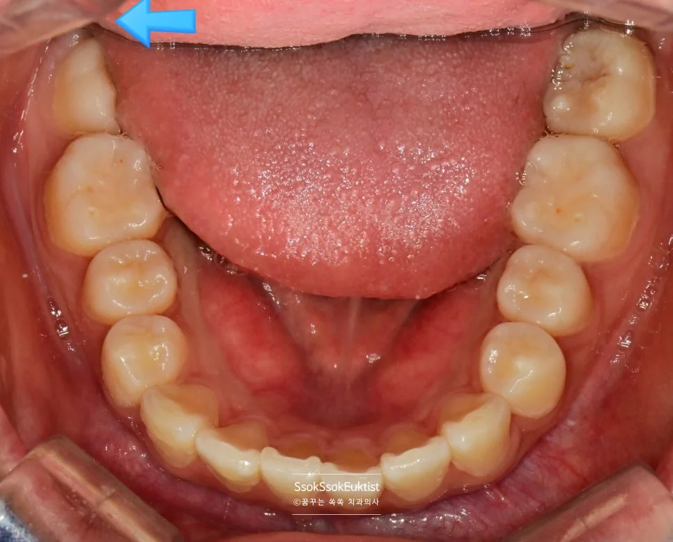 매복 사랑니 맹출 중 잇몸 자극 구내사진 화살표 표시