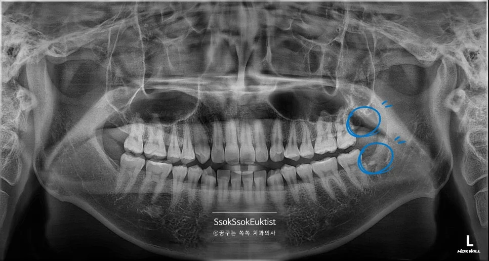 중간 난이도 완전 매복 사랑니 파노라마 엑스레이 파란 원 표시