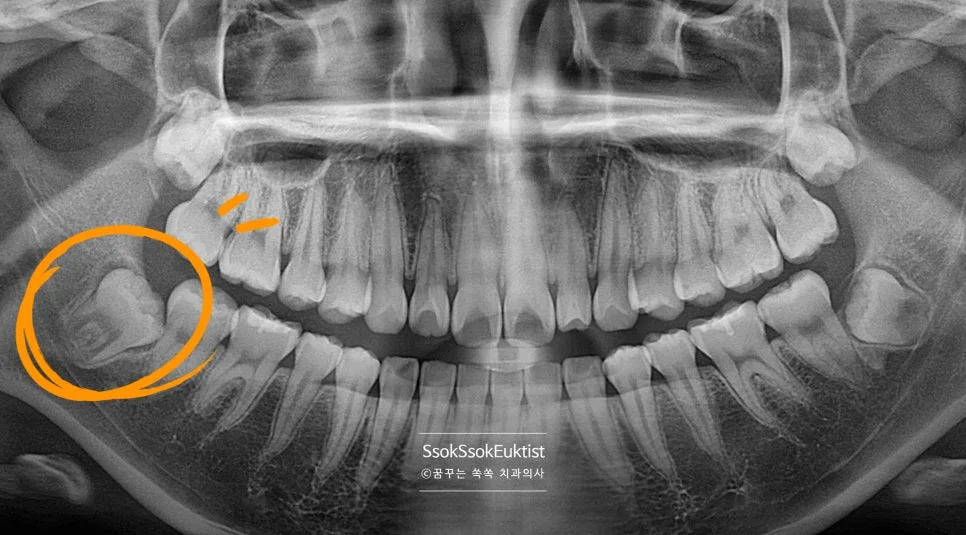 중간 난이도 완전 매복 사랑니 엑스레이 뼈 속 묻힘