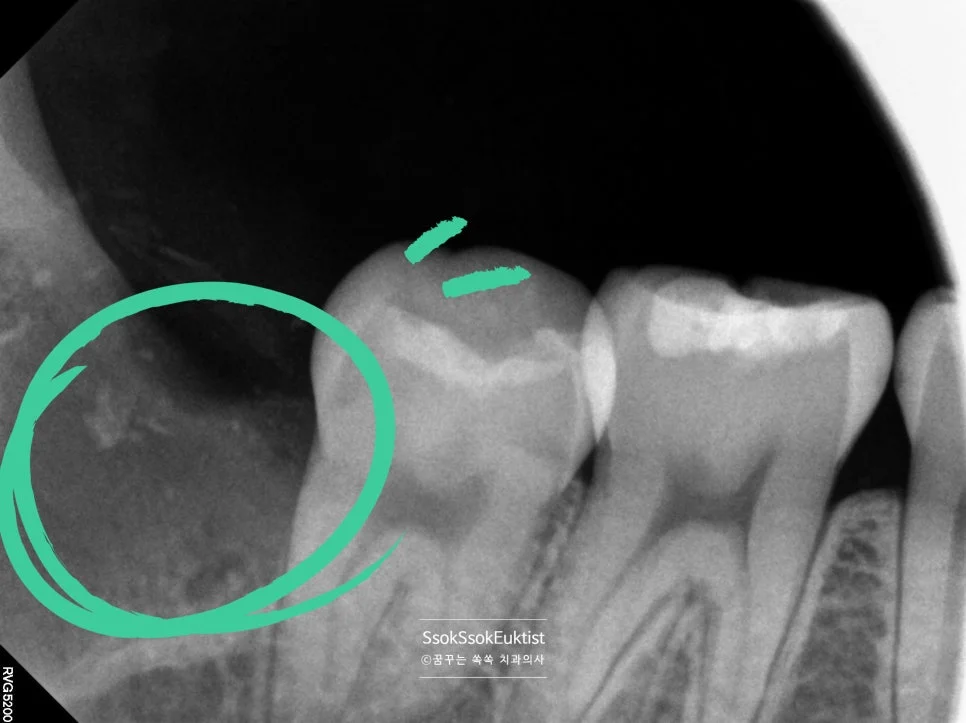 매복 사랑니 엑스레이 녹색 원 신경관 화살표 근접 표시