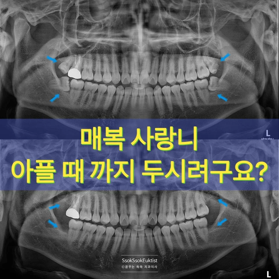 매복 사랑니 파노라마 진단 사진