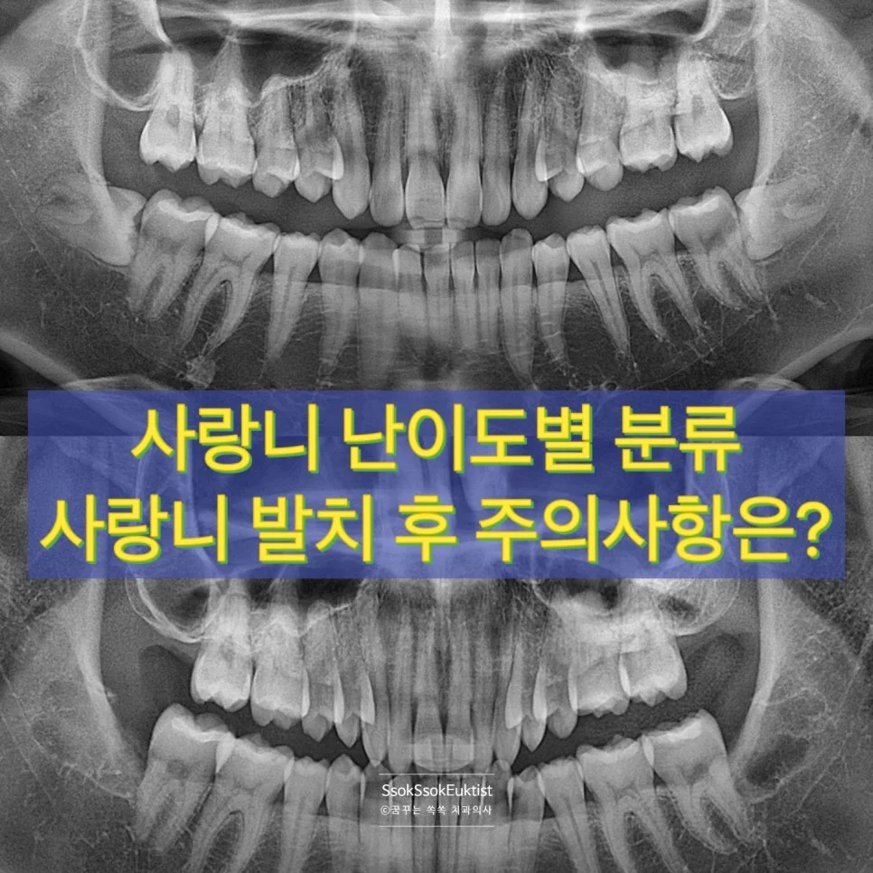 사랑니 발치 전 파노라마 엑스레이 전체 사진 사랑니 위치 확인
