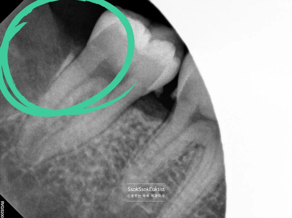 사랑니 발치 후 상악 좌측 X-ray 녹색 마크