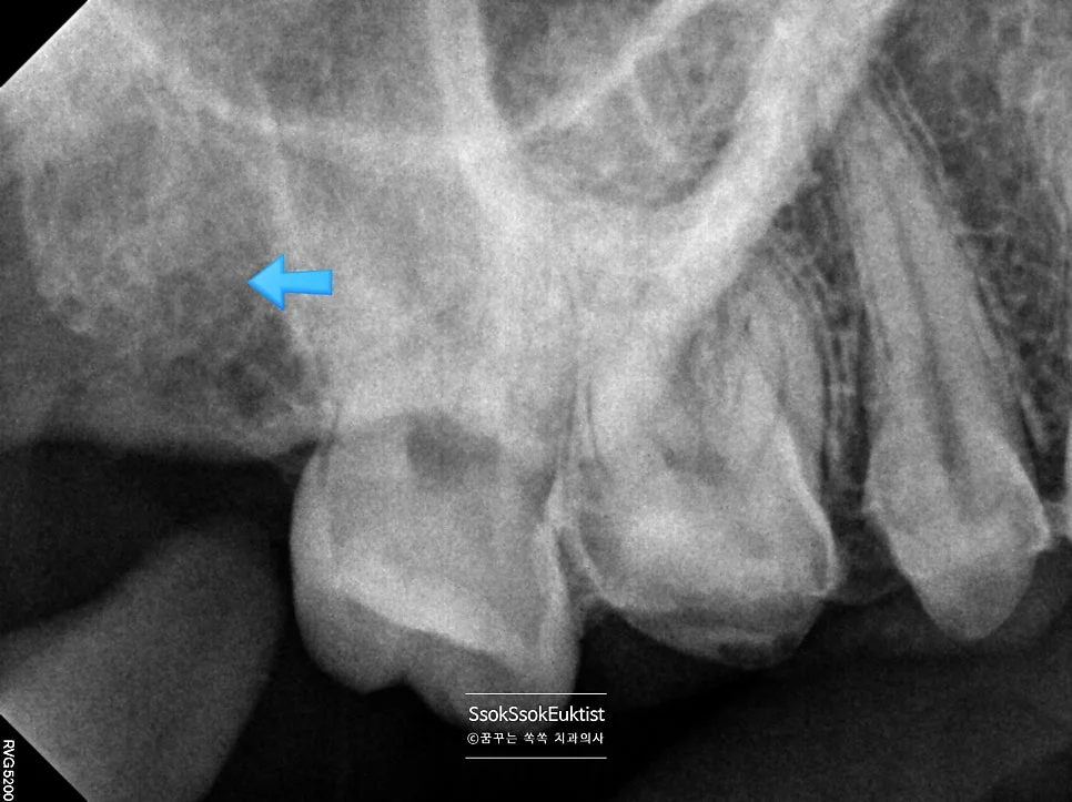 사랑니 발치 후 X-ray