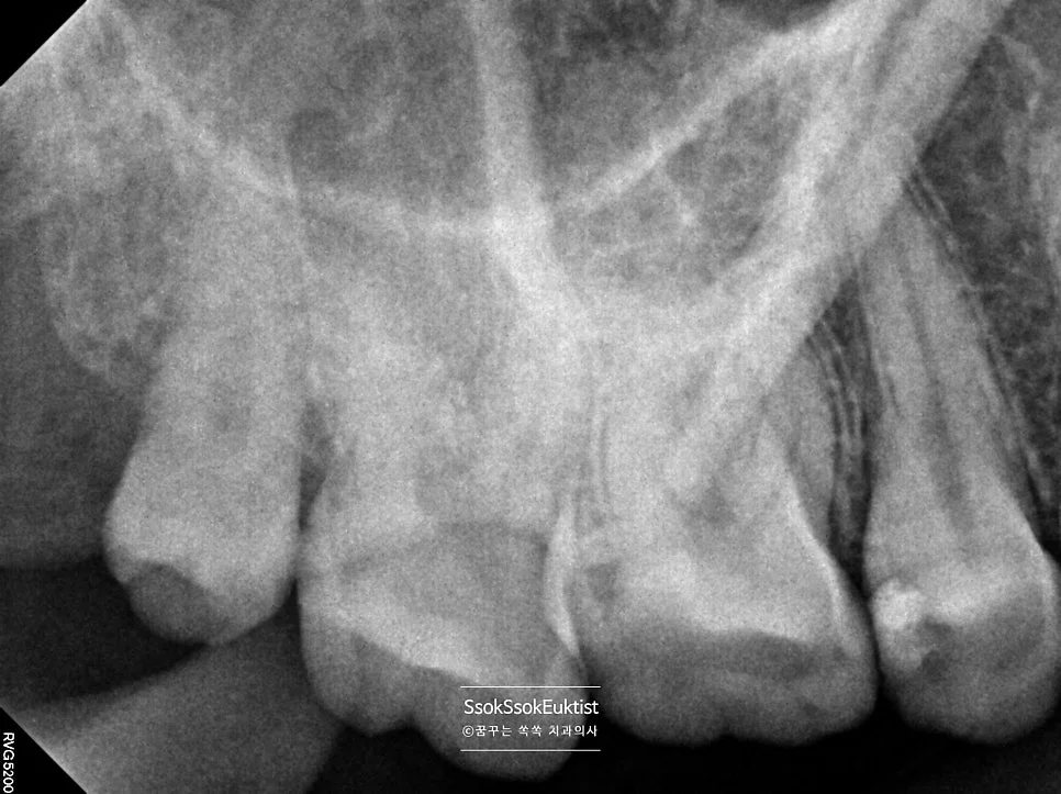 사랑니 발치 방사선 사진