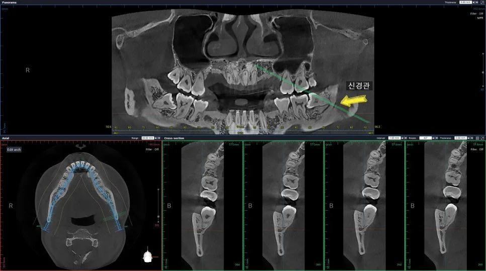 사랑니 CBCT 좌측 하악 신경관 근접 확인