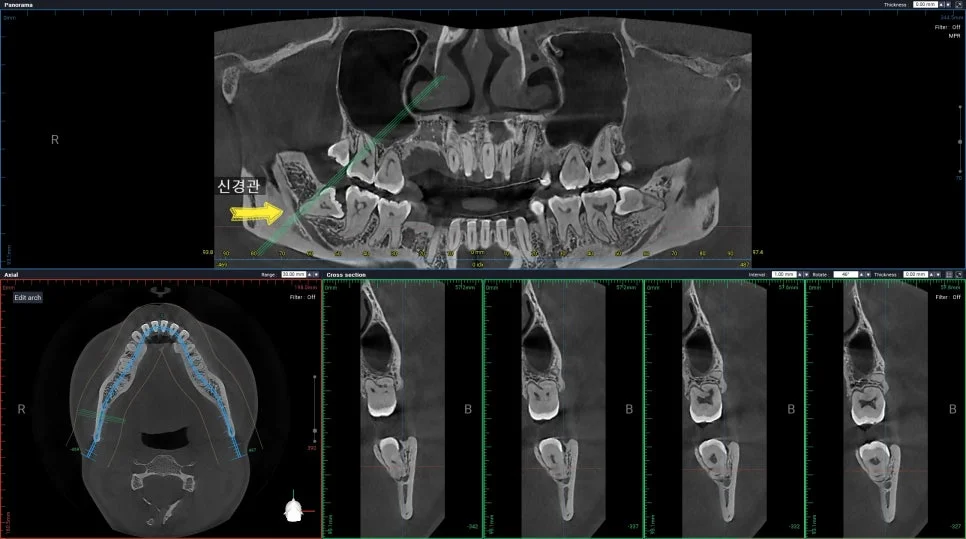 사랑니 CBCT 우측 하악 신경관 근접 확인