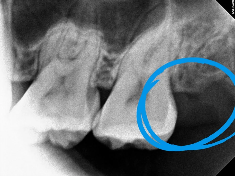사랑니 발치 후 좌측 상악 치근단 X-ray