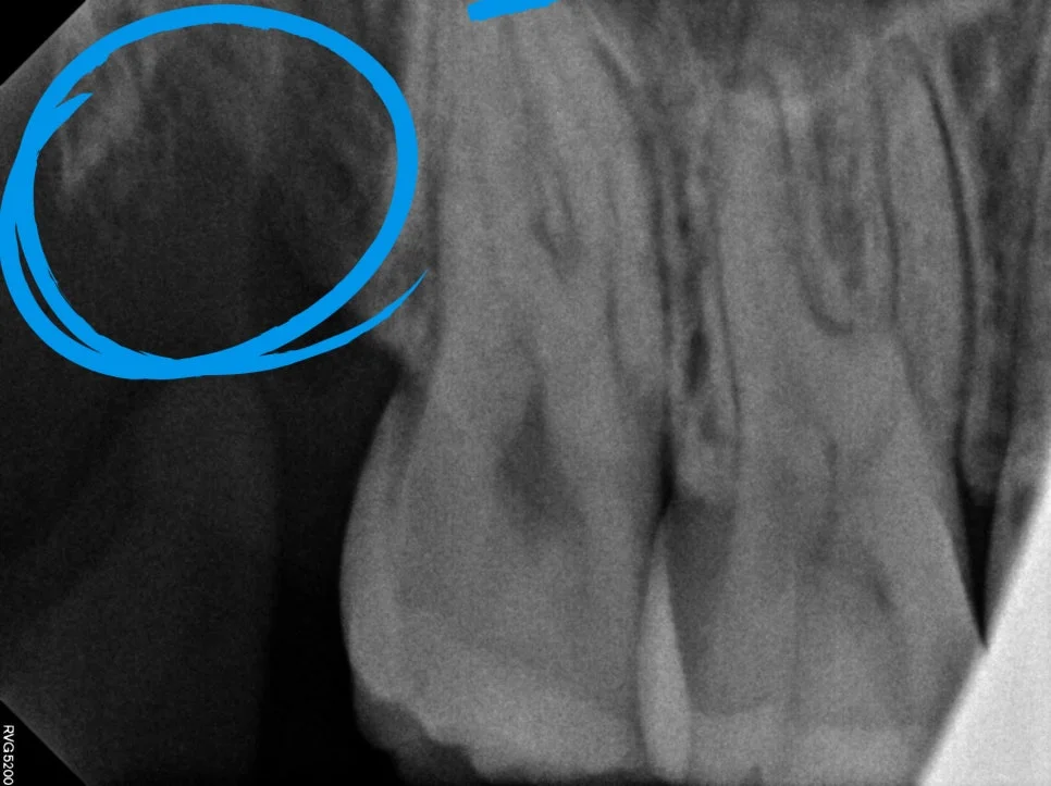 사랑니 발치 후 우측 상악 치근단 X-ray