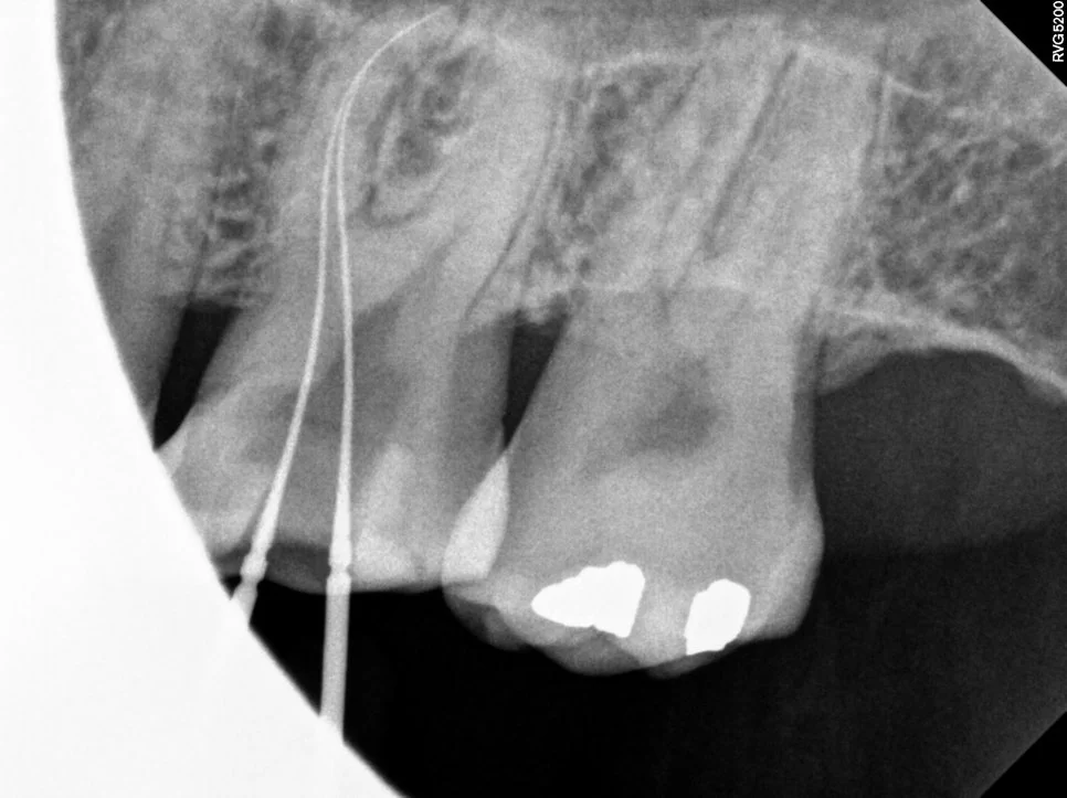 근관 작업장 측정 X-ray - 파일 삽입