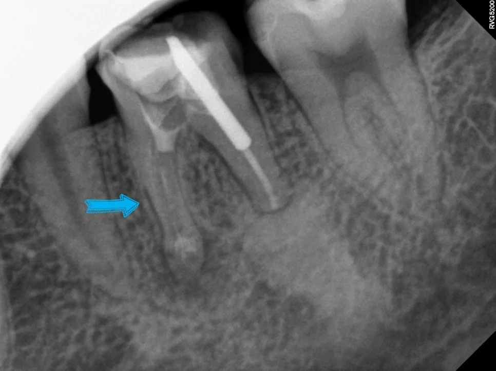 이전 신경치료 재료 제거 후 신경관 소독 과정 엑스레이