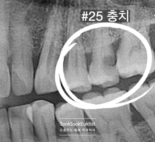 신경치료 전 방사선 촬영 신경관 감염 확인 엑스레이