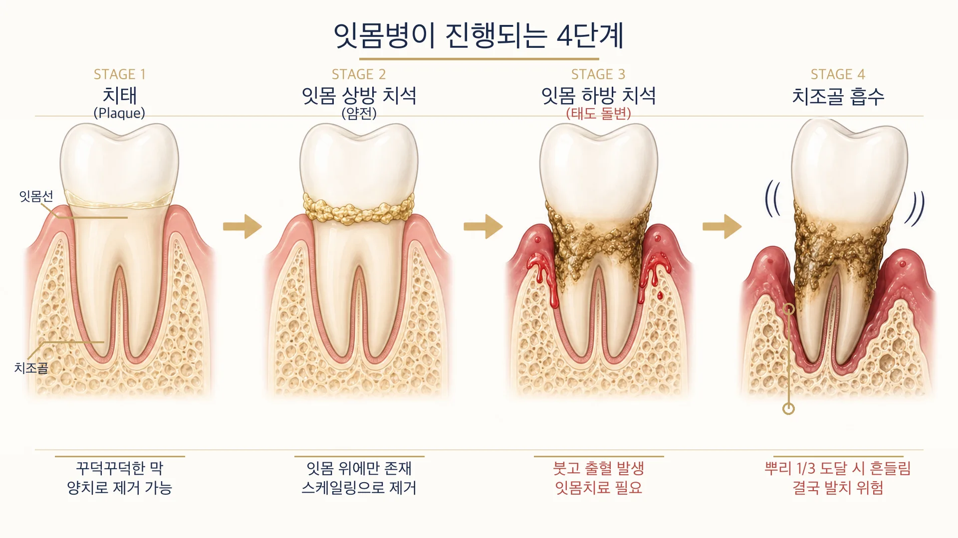잇몸질환 진행 원리 도식, 치태에서 치석과 치조골 흡수로 이어지는 과정