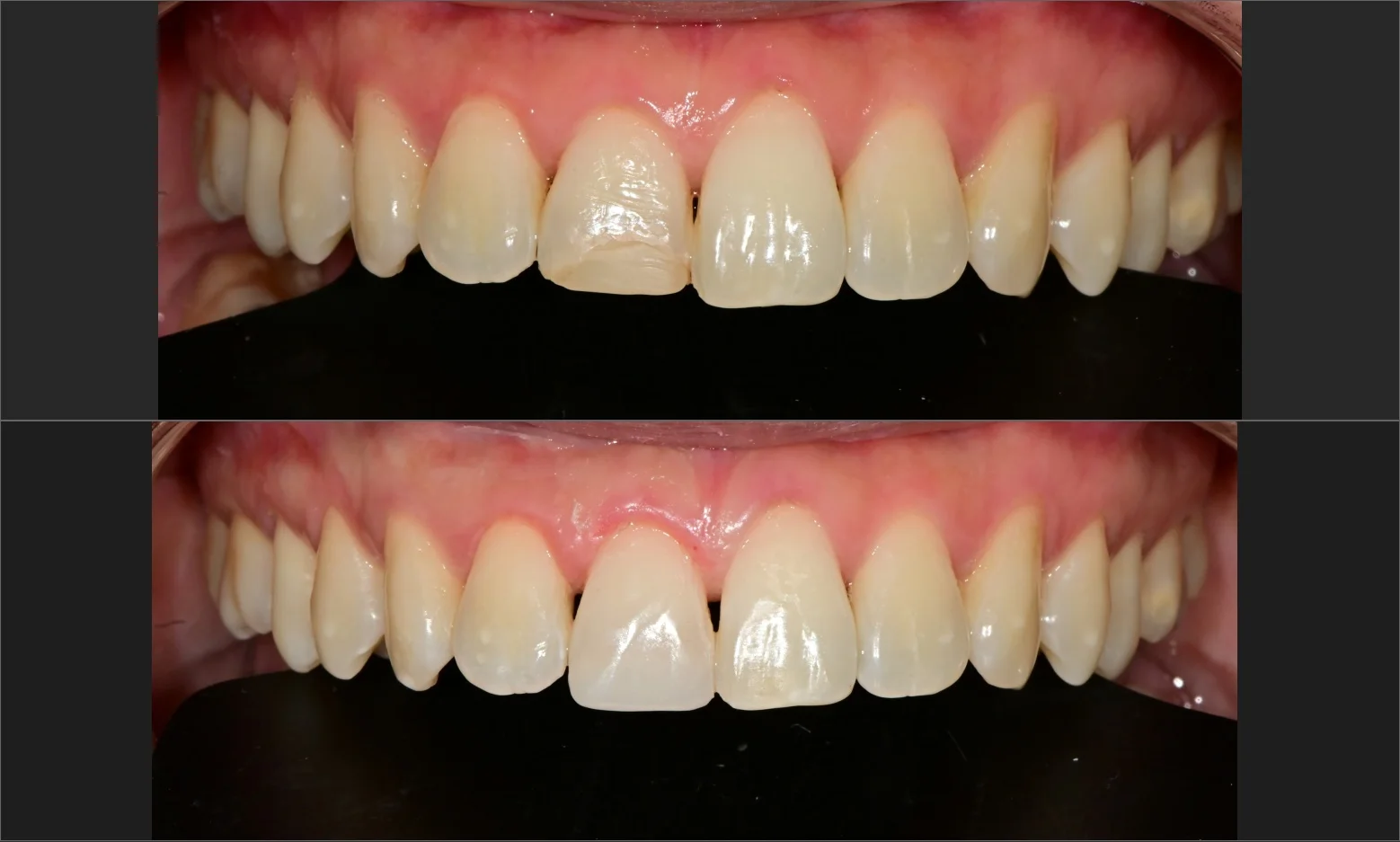 원장님 제작 BEFORE/AFTER 콜라주 — 상단 변색 레진과 사이 공간 / 하단 색 매칭 + 공간 닫힘