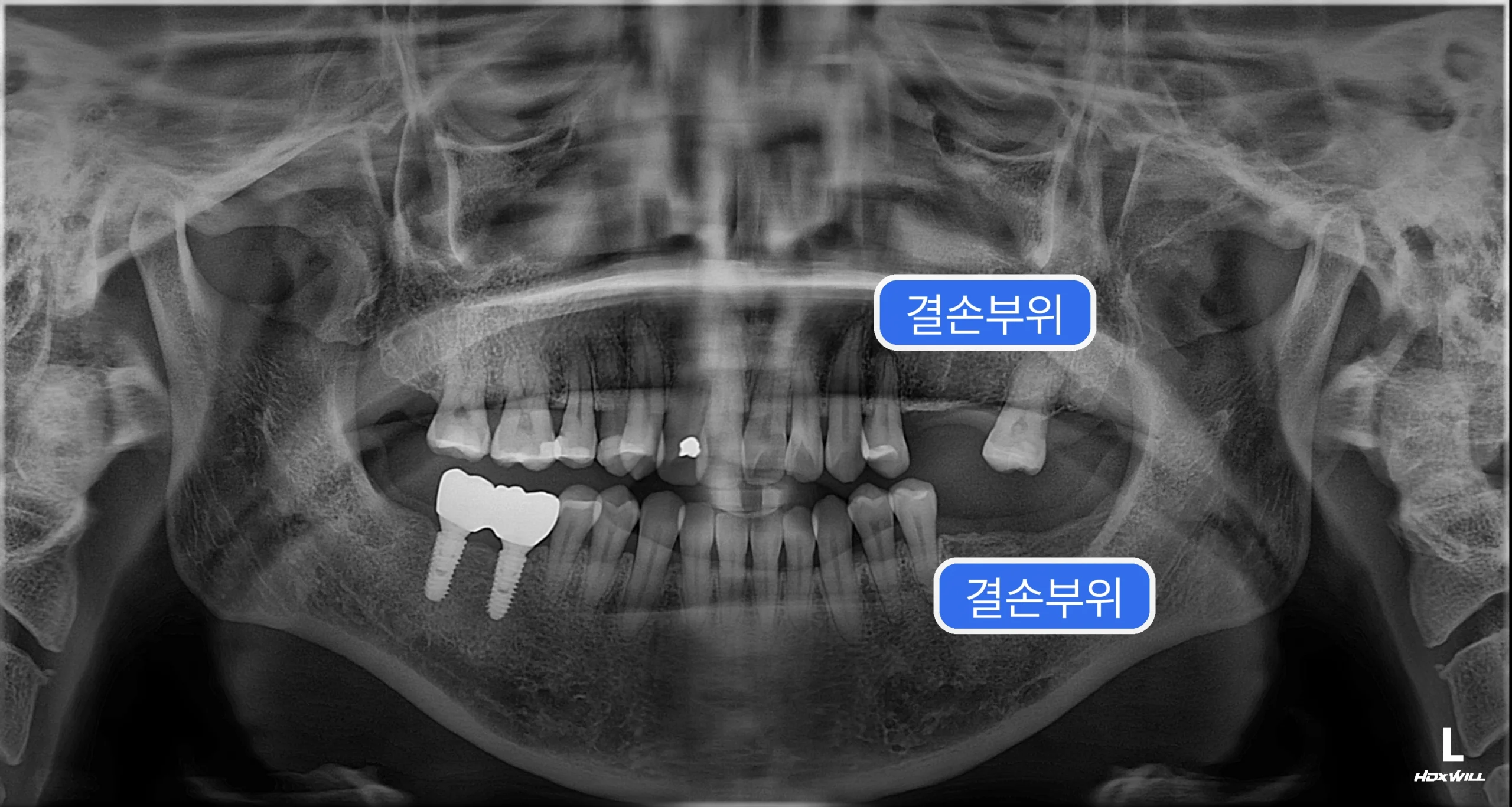 초진 파노라마에서 좌측 상악과 하악 어금니 결손부를 확인하는 장면