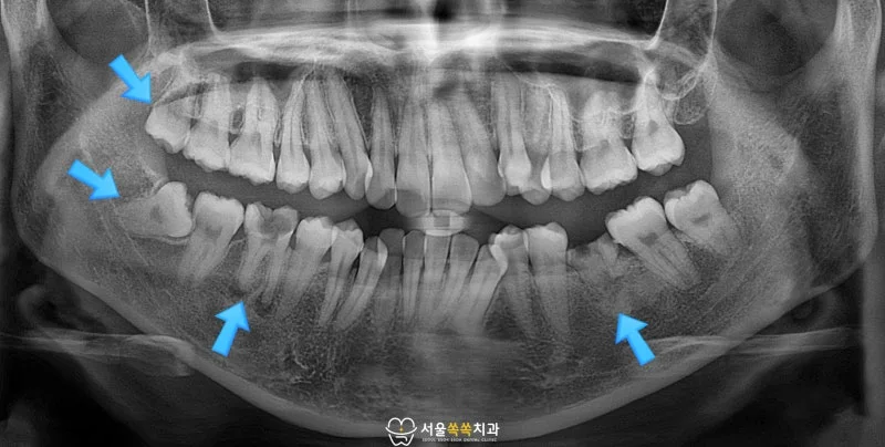 초진 파노라마 — #46 깊은 충치·#48 매복 사랑니·#36 잔존치근 등 다부위 진단