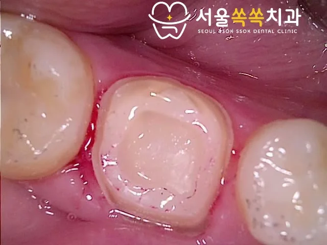 #46 신경치료 후 크라운 prep — 마진 라인 디테일