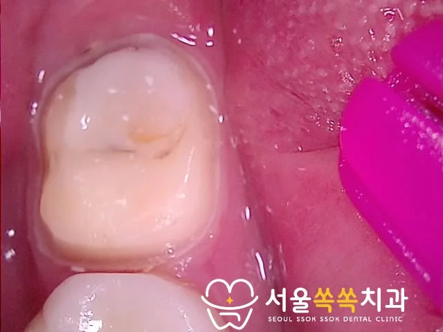 #47 기존 보철 제거 후 노출된 치아 표면 — 크랙(crack) 확인