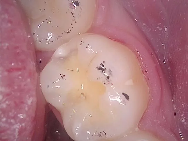 #36 충치 제거 후 — 안쪽 깊게 진행
