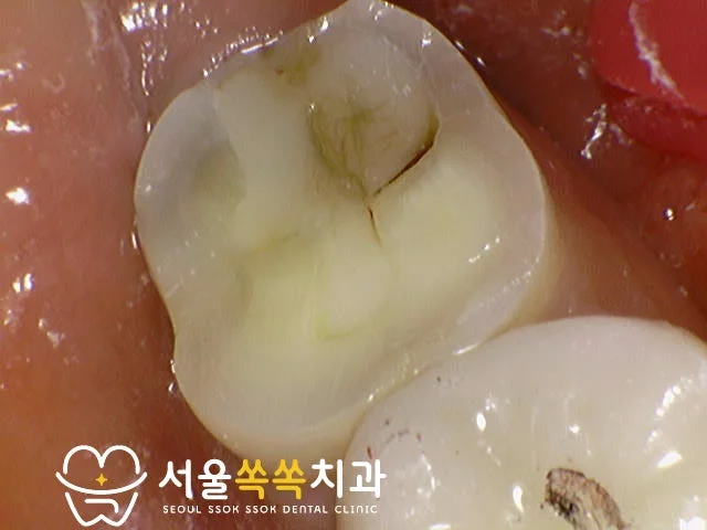 #47 손상된 기존 보철 클로즈업 — 보철물 깨짐과 치아 노출 확인