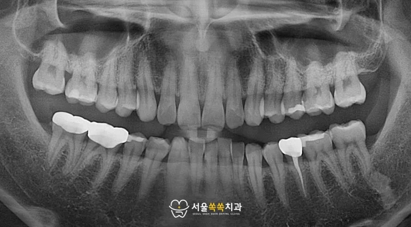 초진 파노라마 — 전체 구강 상태 및 수복물 분포 확인