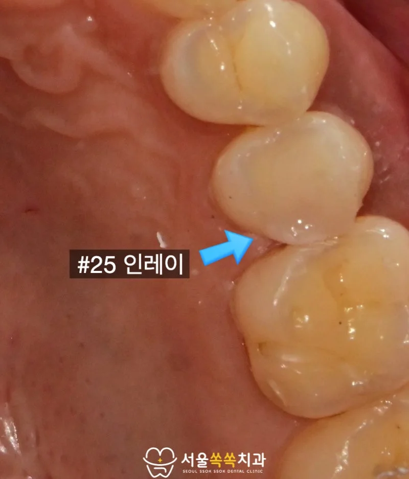 #25 인레이 치료 후 협측 뷰 — 인접면 접촉·색조 회복 확인