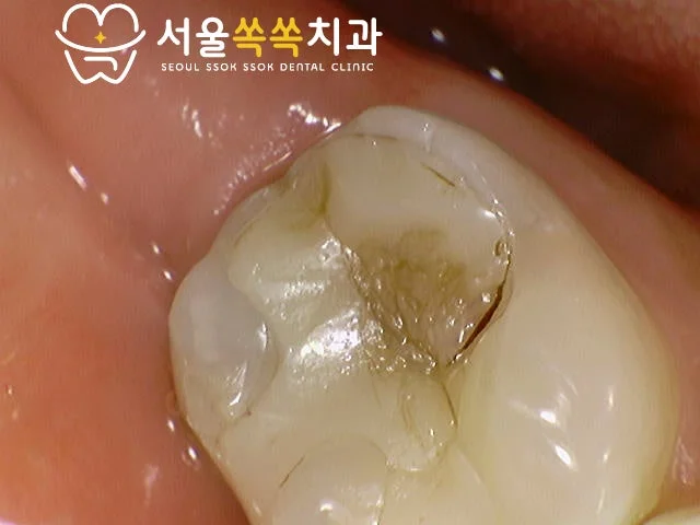 #47 보철과 충치 제거 후 노출된 상아질 — 크라운 prep 직전 상태
