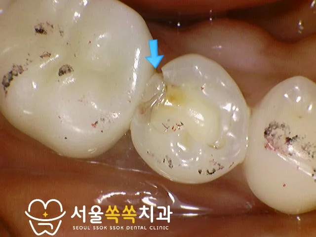#45 인접면 충치를 수복물 제거 후 직접 노출 확인