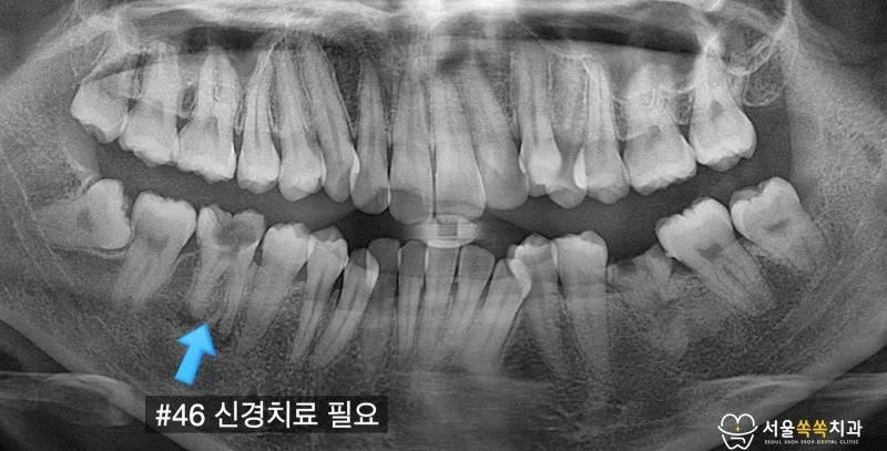#46 깊은 충치 부위 파노라마 크롭 — 신경치료 필요